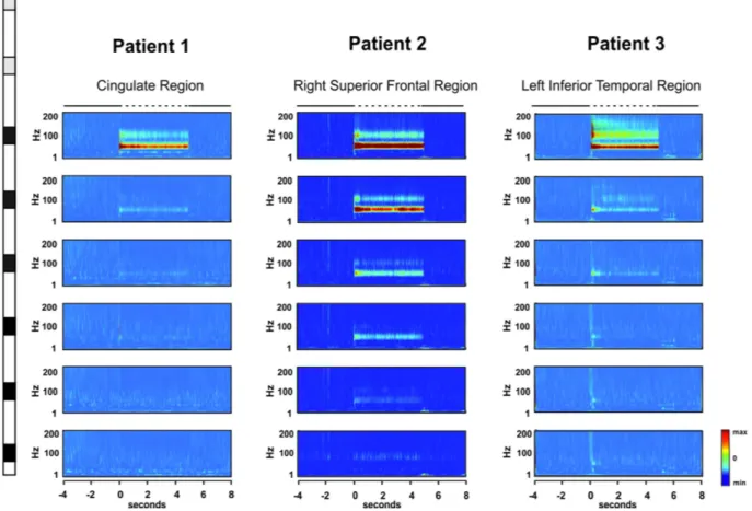 Figure 3.  Time-Frequency activity maps for each individual patient included in the study