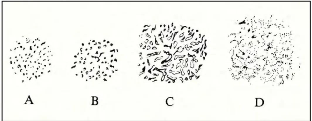 Figure 16 : Stades de développement de la lésion Cribra orbitalia. A : type poreux ; B : type criblé ; C : type  trabéculaire ; D : lésion remodelée (Brothwell 1981 p