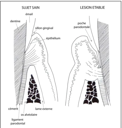 Figure 11 : Coupe des tissus parodontaux : à gauche, individu sain ; à droite, lésion établie (d’après Hillson  1996, p
