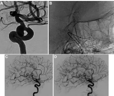 Figure 3  (A) Internal carotid artery/carotidophthalmic aneurysm. (B)  Treatment with the FRED device