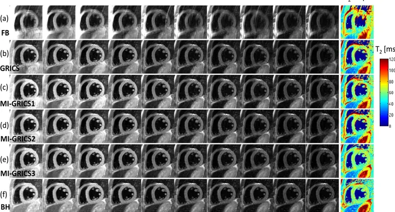 Fig.  1.    Example  myocardial  T2  quantification  image  series  (effective  echo  times  TE  ranging  from  10  to  80  ms)  and  resulting  T2  map  obtained  from  free- free-breathing  experiments:  uncorrected  (a);  with  conventional  GRICS  reco