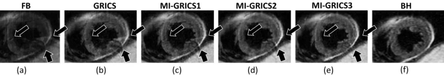 Fig.  2.    Comparison  of  the  image  quality  in  patient  2  (image  at  TEeff=70  ms)  obtained  from  free-breathing  data,  including  uncorrected  (a),  GRICS  (b),  MI- MI-GRICS1 (c),MI-GRICS2 (d) and MI-GRICS3 (e) correction, with the breath-held