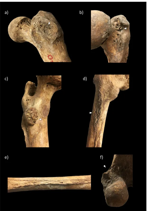 Figure 13. Examples of entheseal changes that were analyzed on the femur: a) anterior  surface of greater trochanter (FEM E1); b) trochanteric fossa (FEM E3); c) lesser  trochanter (FEM E4); d) gluteal tuberosity (FEM E5); e) linea aspera, medial and later