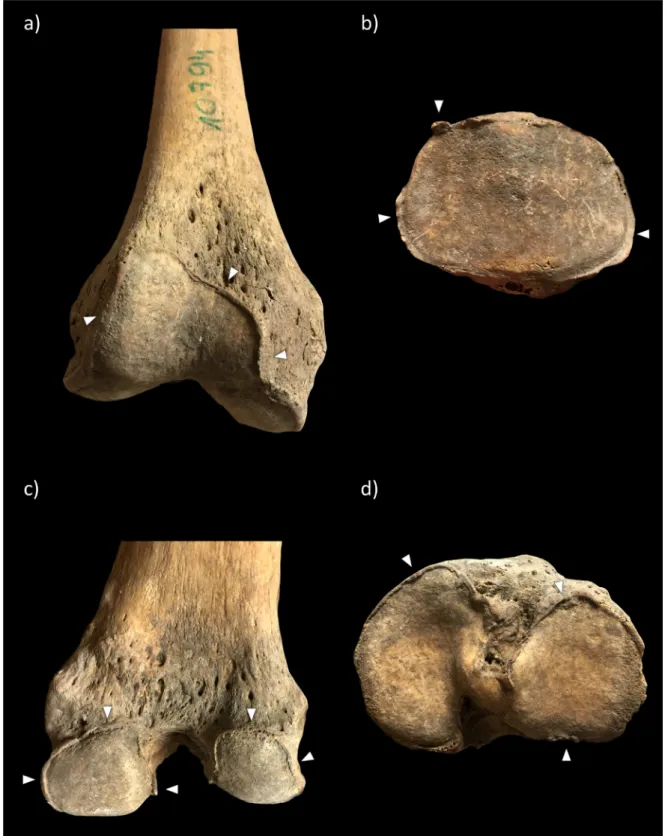 Figure 15. Examples of changes scored at the a) patellar surface of the patellofemoral joint; 