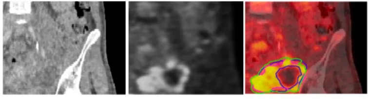 Figure 5: From left to right: contrast-enhanced CT, PET and fusion of the two modalities; coronal view of the left side of the pelvic area