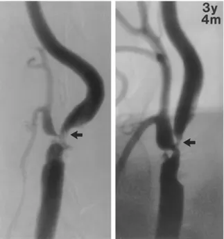 Figure  16.  Exemple d’images obtenues par angiographie. Bifurcation carotidienne et  progression de la sténose après 3 ans et 4 mois (3y4m) entre la figure de gauche et celle de  droite (Akins, Pilgram et al