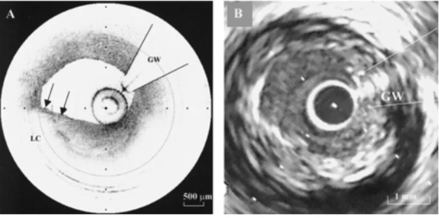 Figure  20.  Imagerie intracoronarienne in vivo  d’une plaque possédant un cœur riche en  lipides par OCT (A) et IVUS (B)