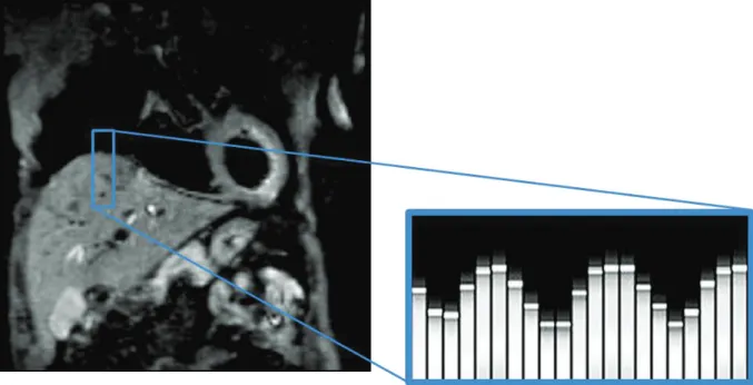 Figure 3.19: Navigator is place on the dome of the liver to derive the interface  lung/liver