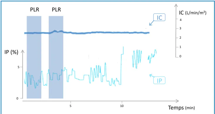 Figure 15 : Courbe de l’indice de perfusion (IP) et de l’index cardiaque (IC) lors de deux tests de  passive leg raising (PLR 1 et 2) chez un patient avec un signal d’IP instable lié à une fibrillation atriale