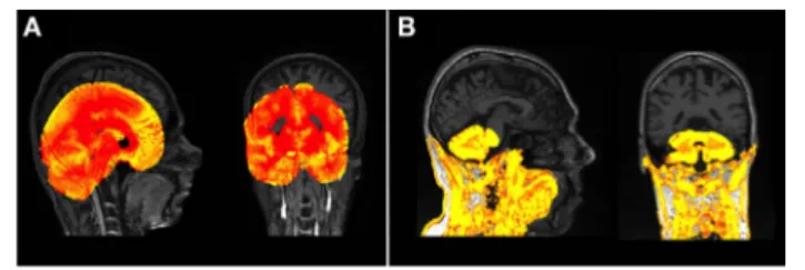 FigUre 1 | (a) An example of a gross failure on a Track-Huntington’s  disease (HD) scan when using Statistical Parametric Mapping (SPM) 8 Unified  Segment