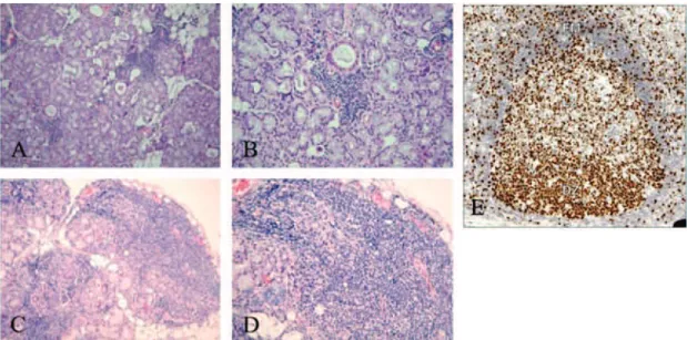 Figure  13.  Periductal  focal  mononuclear  cell  infiltrates  in  the  minor  salivary  gland  biopsies  of  patients  with  pSS  (A  and  B)  and  salivary  gland tissue GC-like structures (C and D)