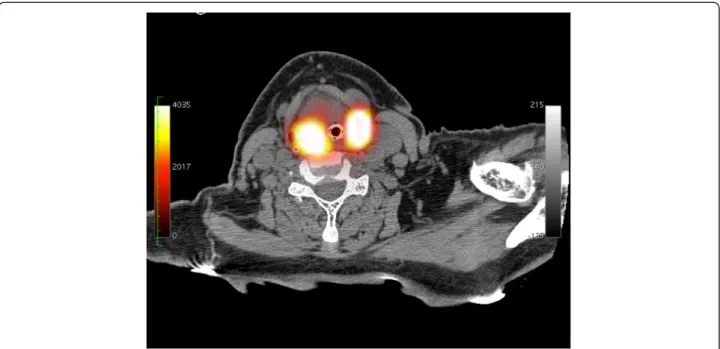Figure 1 Axial SPECT/CT slice, patient 6. No apparent migration is depicted in level 3 left, probably due to intense activity in neighbouring tumour.