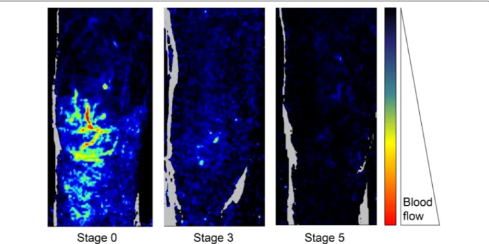 Fig. 2  Examples of skin microcirculatory endothelial reactivity in  the knee area in a patients with sepsis, in a patient with septic shock  that was alive at day 14 and in a patient with septic shock that was  ultimately dead at day 14