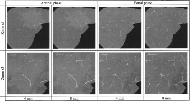 Fig. 5.  Simulation of CT scans during the contrast medium (CM) propagation, with two spatial  resolutions (zoom  2 1, 2 2) and two slice thicknesses’ (4 mm, 8 mm)