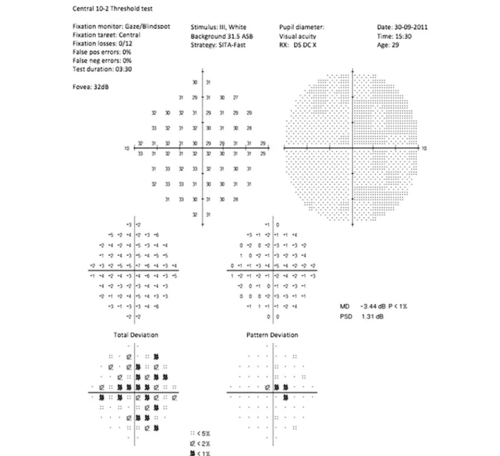 Fig. 3 Visual fields in a patient with an asymptomatic eye at the initial visit. Despite normal visual acuity (20/20), there is a relative central depression on the pattern deviation plot