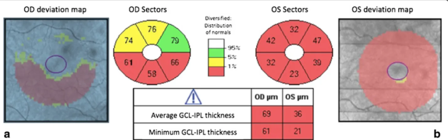 Fig. 4 Optical coherence tomography, GC-IPL thickness map. a SD-OCT showing the GC-IPL thickness map in the right unaffected eye at baseline examination; in the inferior sector, there is a thinning of the GC-IPL before the acute stage of the disease