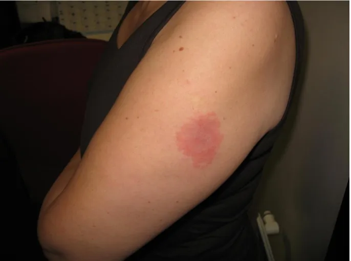 Figure 1 Eczema lesion of left shoulder, three days after the beginning of the rash (25 days  after the H1N1 vaccine shot)