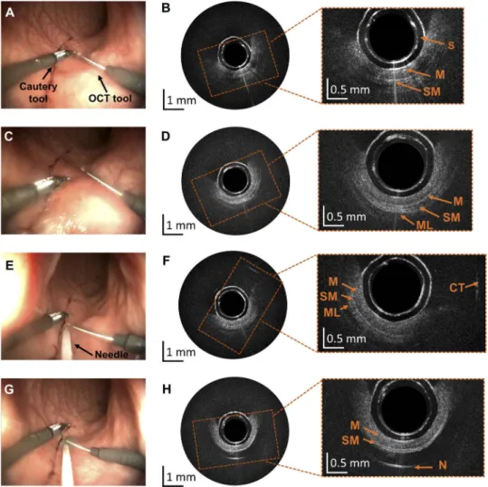 Fig. 8. Results obtained during experiments in the swine bowel in vivo. (A, C) Screenshots from the white light endoscopic camera of the robotized endoscope showing a cautery tool and the steerable OCT catheter in two position