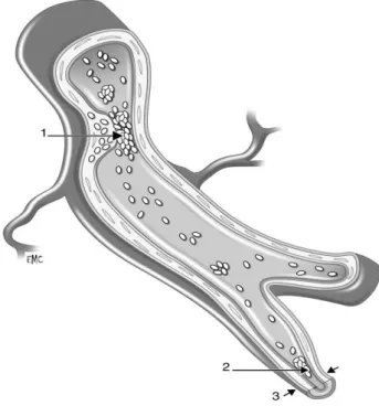 Figure 2 : Physiopathologie de l’infarctus du myocarde [9] 