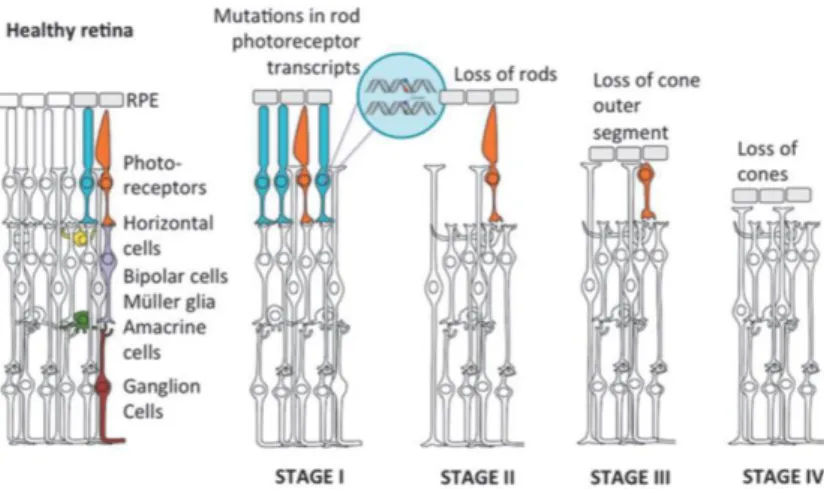 Figure 7. Retinitis pigmentosa as an example of retinal degeneration progression. 