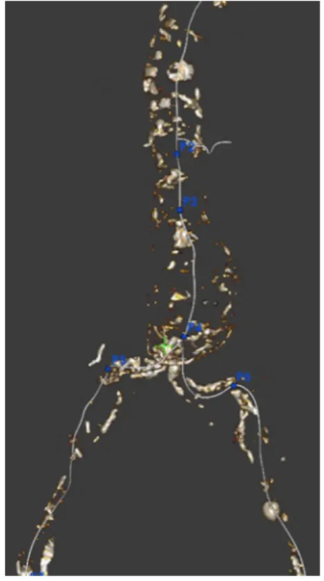 Fig. 1 Non injected 3D aortic volume. For sizing and planning 5 keys points are placed: 