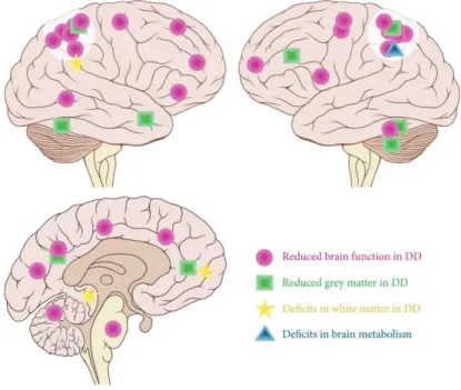Figure 5. Principales anomalies cérébrales associées à la dyscalculie (d’après Kucian et al, 2014)