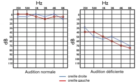 Figure  1.7 :  Audiogrammes  d’une  audition  normale  et  déficiente.  L’audition  déficiente  est  particulièrement touchée dans les hautes fréquences (i.e., sons aigües)