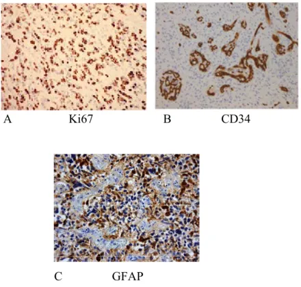 Figure  2  :  Immunohistochimie  sur  coupes  de  glioblastomes.  (A)  Marquage  de  l’activité  proliférative par l’anticorps MIB-1 dirigé contre la protéine Ki67