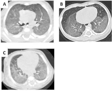 Fig. 1: Four-year-old boy with SFTPC mutation. HRCT section through the carina shows diffuse and  uniform ground-glass opacities (A).Two-year-old girl with SFTPC mutation