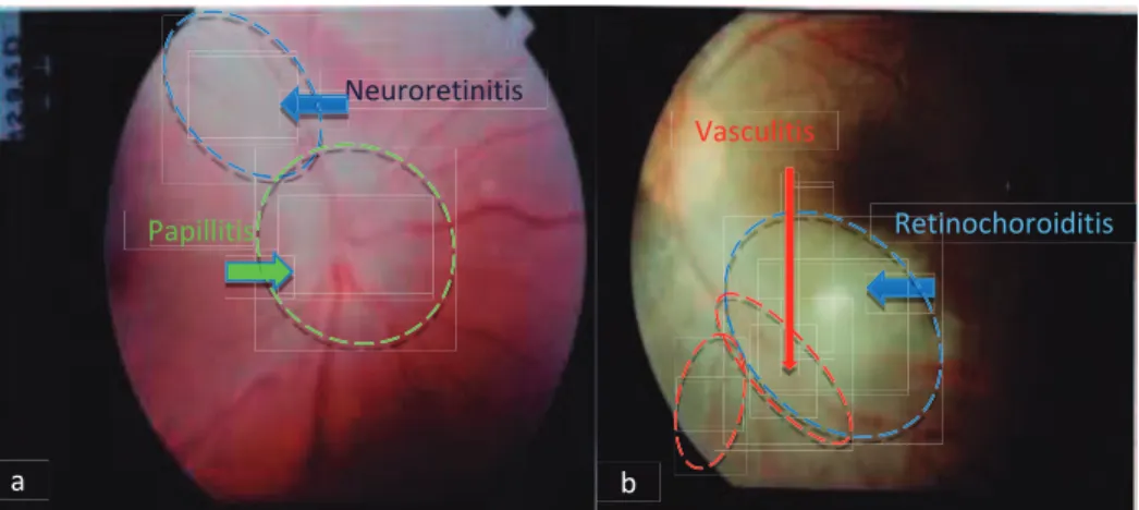 Figure 9. OT complication: retinal detachment. 