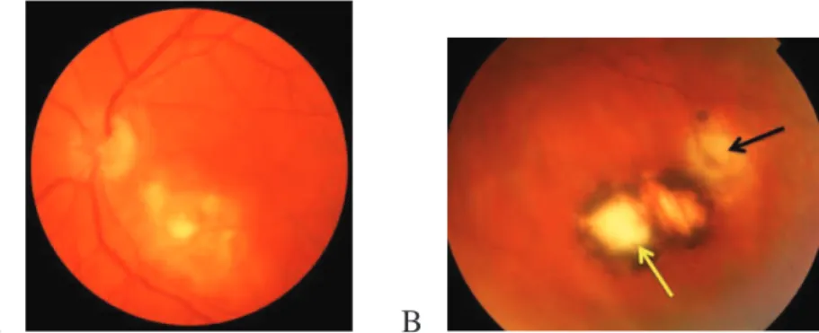 Figure 6 : A : Rétinochoroïdite toxoplasmique active #$%&amp;''()*+,*-).)/)0)1234%%5635)78465)9:)0);&lt;=3&gt;5)?@465) cicatrice, flèche noire lésion active.