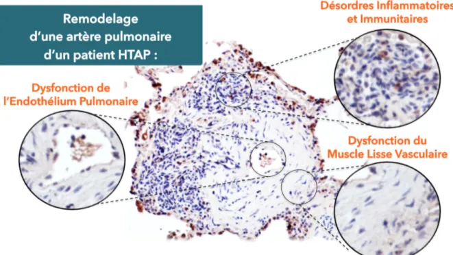 Figure 1 : Les trois composantes du remodelage vasculaire pulmonaire associé à l’hypertension artérielle  pulmonaire  (HTAP)