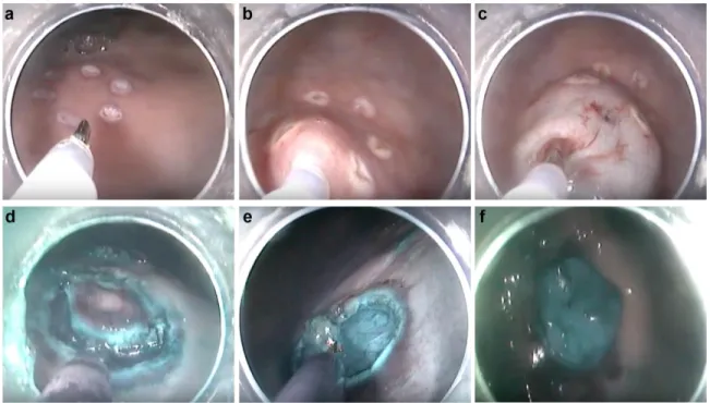 Figure 7. Endoscopic views of the different steps of the ESD procedure performed using the dPAA stained  with Methylene Blue