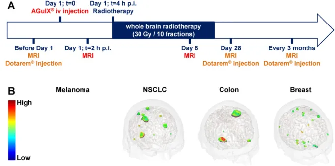 Figure 6. Phase Ib clinical trial assessing AGuIX® NP radiosensitization. A. Protocol for the clinical trial of phase Ib (NCT03308604, NANORAD) to assess  radiosensitization of multiple brain metastases using AGuIX® NP