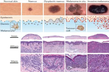 Figure 1: Spectre morphologique des néoplasmes mélanocytaires. Ligne du haut: Des images cliniques montrent un  naevus  autonome,  un  naevus  dysplasique,  un  mélanome  in  situ  et  un  mélanome  invasif