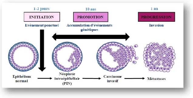 Figure 05 : Stades d’évolution du cancer de la prostate : Après une phase d’initiation marquée par  un évènement ponctuel, l’étape de progression entraîne l’apparition de néoplasie intraépithéliale  puis d’un carcinome invasif