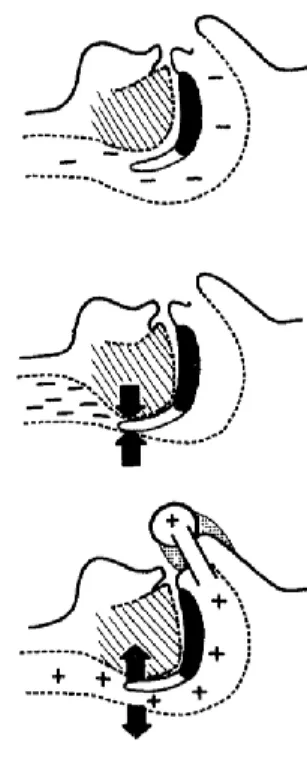 Figure 1-2 Le traitement du SAHOS par PPC (Sullivan et al. 1981). Panel du haut : les voies  aériennes supérieures sont maintenues ouvertes par le tonus musculaire pendant l’éveil du patient