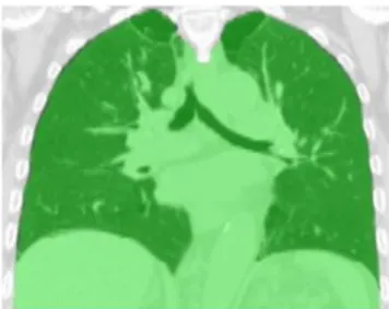 FIGURE 3.7: The motion mask (green) is superimposed on the CT image 