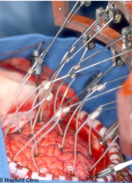 Figure 1.2: Intracerebral electrodes are surgically implanted into the brain tissue to map the seizure activities before removing brain structures [Ellen 2015].