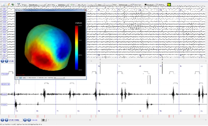 Figure 4. Illustration of the visual rendering of a high frequency oscillation (red arrow) at two  different time scales