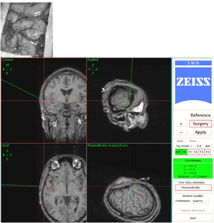Figure 5 a) : Patient 2 : superposition des sillons choisis et visualisés dans l’oculaire du microscope  sur les sillons réels