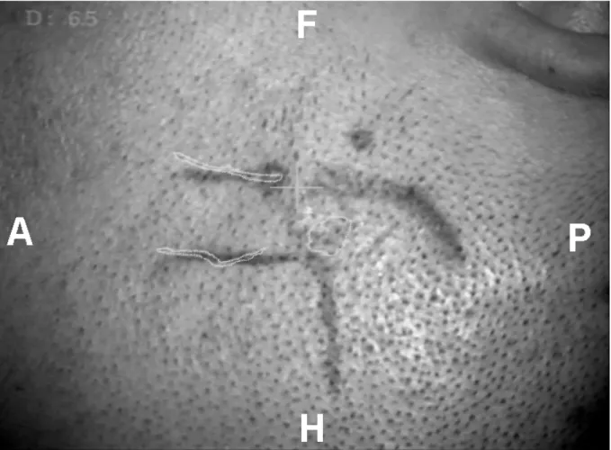 Figure 9 : Patient 7 : la superposition du cavernome et des sillons choisis sur la peau permet de  tracer l’incision cutanée