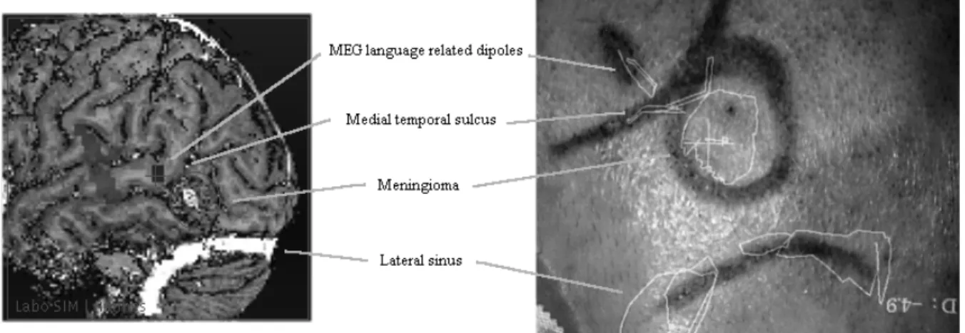 Figure 6: Pre-operative and intra-operative views of the selected entities (Patient B)