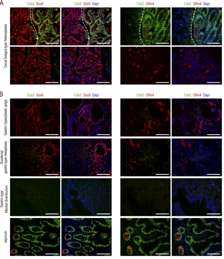 Figure 4.  Comparative expression patterns of the Cdx2, Sox9, and Olfm4 proteins in gastrointestinal lesions