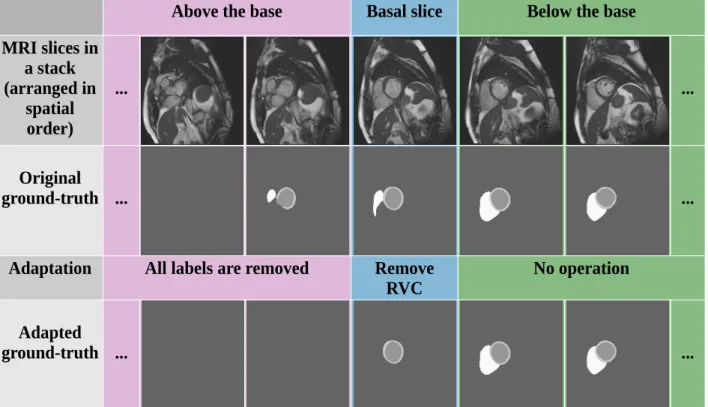 Figure 3.2: Ground-truth adaptation proposed for UK Biobank. the basal slice is first identified (blue), then the RVC labels are removed in this slice, and the labels are removed from the slices above (pink).