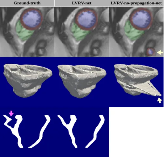 Figure 3.11: An example of the segmentation on difficult slices (zoomed-in versions of ROIs for better visualization) and the reconstructed meshes with the  ground-truth, the prediction of LVRV-net and that of the LVRV-no-propagation-net