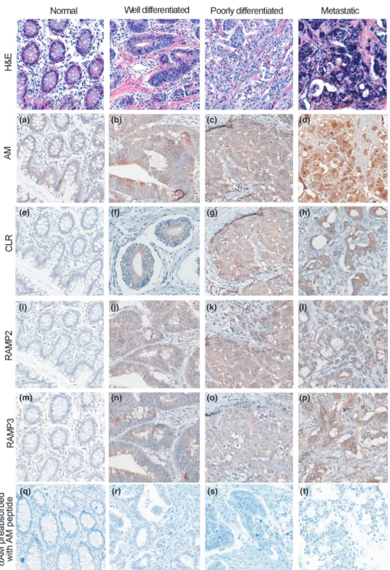 Figure 2. Immunohistochemistry for AM, CLR, RAMP2, and RAMP3 of the normal and tumor colorectal tissues