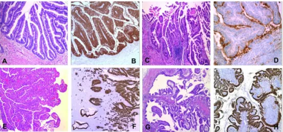 Figure 4. Histopathological subtypes of IPMN of the pancreas and their typical mucin patterns