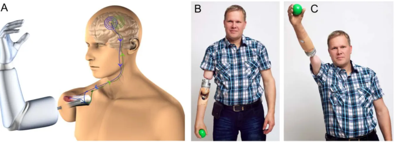 Figure 4: Illustration and use of an osseointegrated arm prosthesis.  