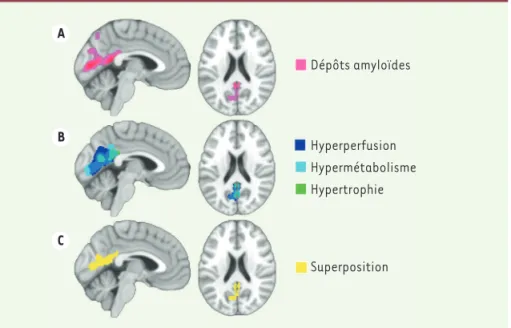 Figure 1. Profil d’atteintes cérébrales associées à la présence d’apnées obstructives du sommeil  chez les personnes âgées sans troubles cognitifs